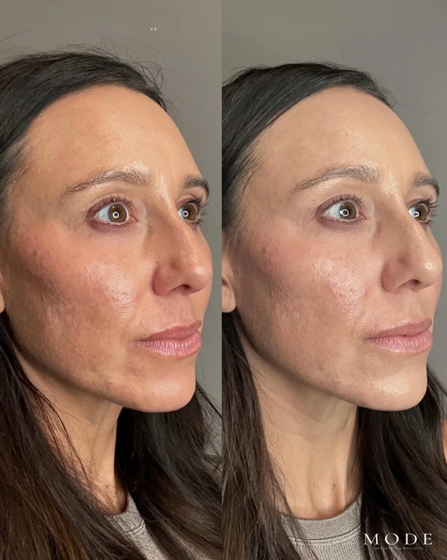 Before and after dermal filler in the chin, pre-jowl area, mid face, and cheeks at MODE in Scottsdale: the same patient in three quarter view before treatment on the left, and after a small amount of hyaluronic acid filler placed for structure rather than volume on the right. Individual results vary.