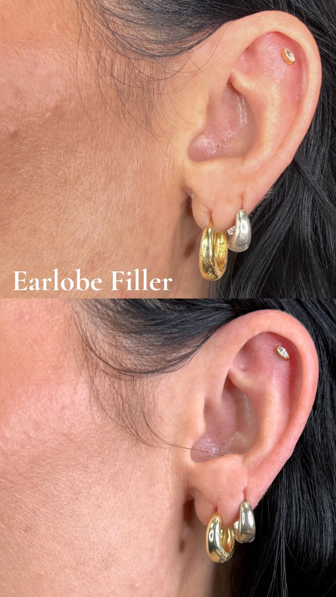 Before and after earlobe filler at MODE in Scottsdale: a patient's earlobe with creasing and lost volume above, and restored fullness after hyaluronic acid filler below, placed by Torey Varner, RN.