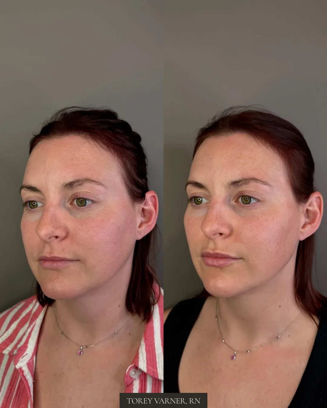 Before and after facial balancing filler at MODE in Scottsdale, placed by Torey Varner, RN.