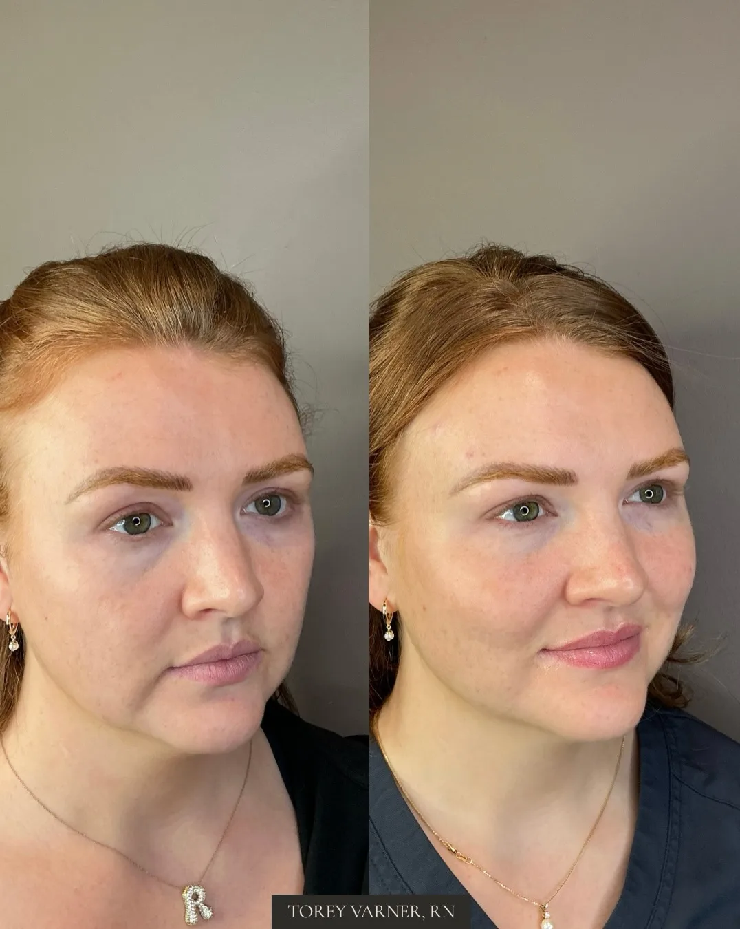 Before and after a first filler appointment at MODE Aesthetics and Wellness in Scottsdale: the same patient in three quarter view before treatment on the left, and after two syringes of hyaluronic acid cheek filler in the mid face with Dysport in the upper face on the right, placed by Torey Varner, RN. Individual results vary.