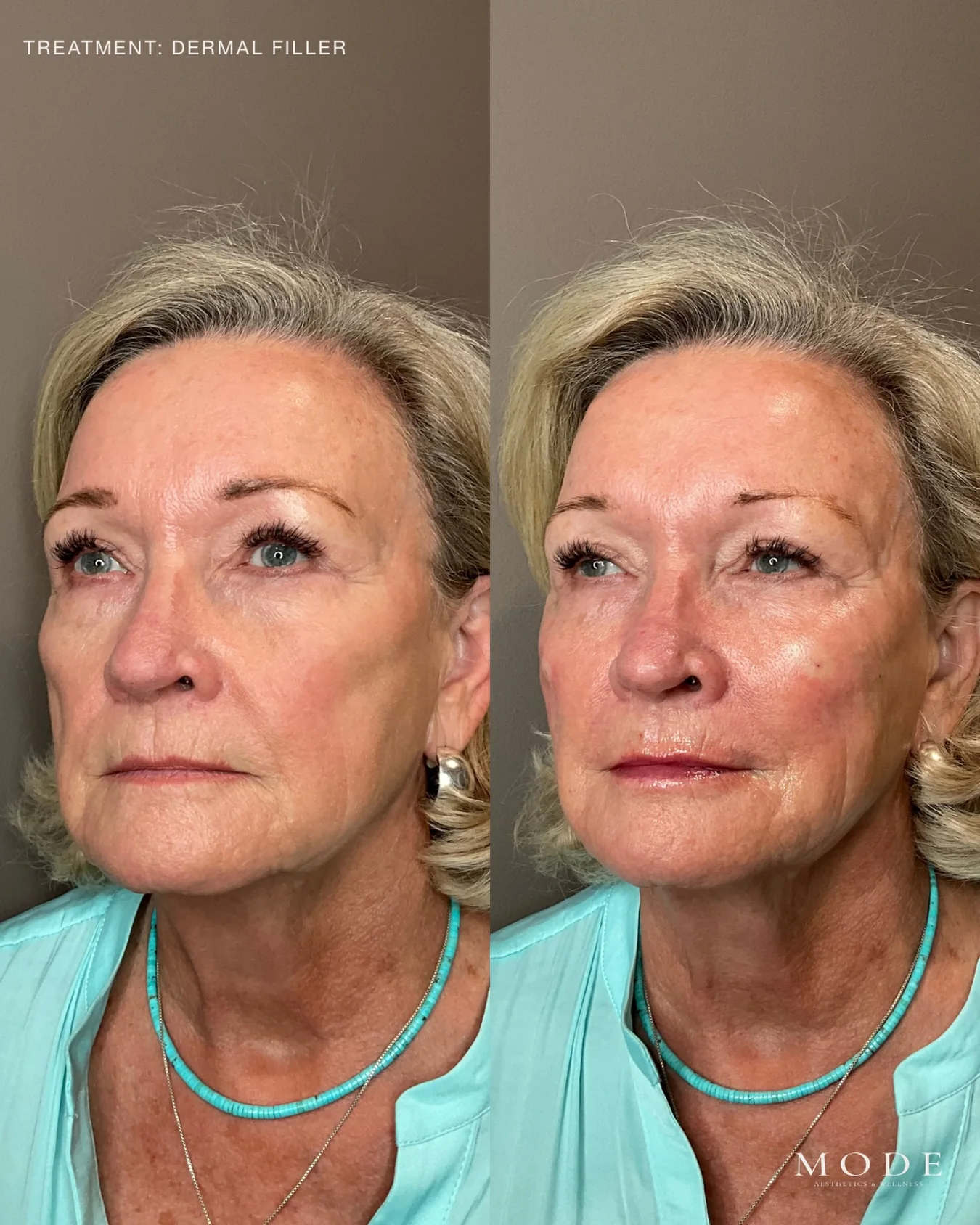 Before and after dermal filler in the mid face and lips at MODE in Scottsdale: the same patient in three quarter view before treatment on the left, and after a small amount of hyaluronic acid filler placed to support the mid face and balance the lips on the right. Individual results vary.